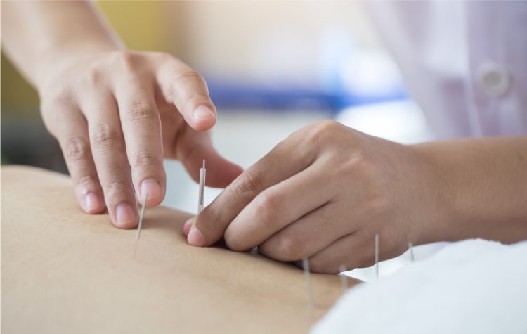 鍼灸施術